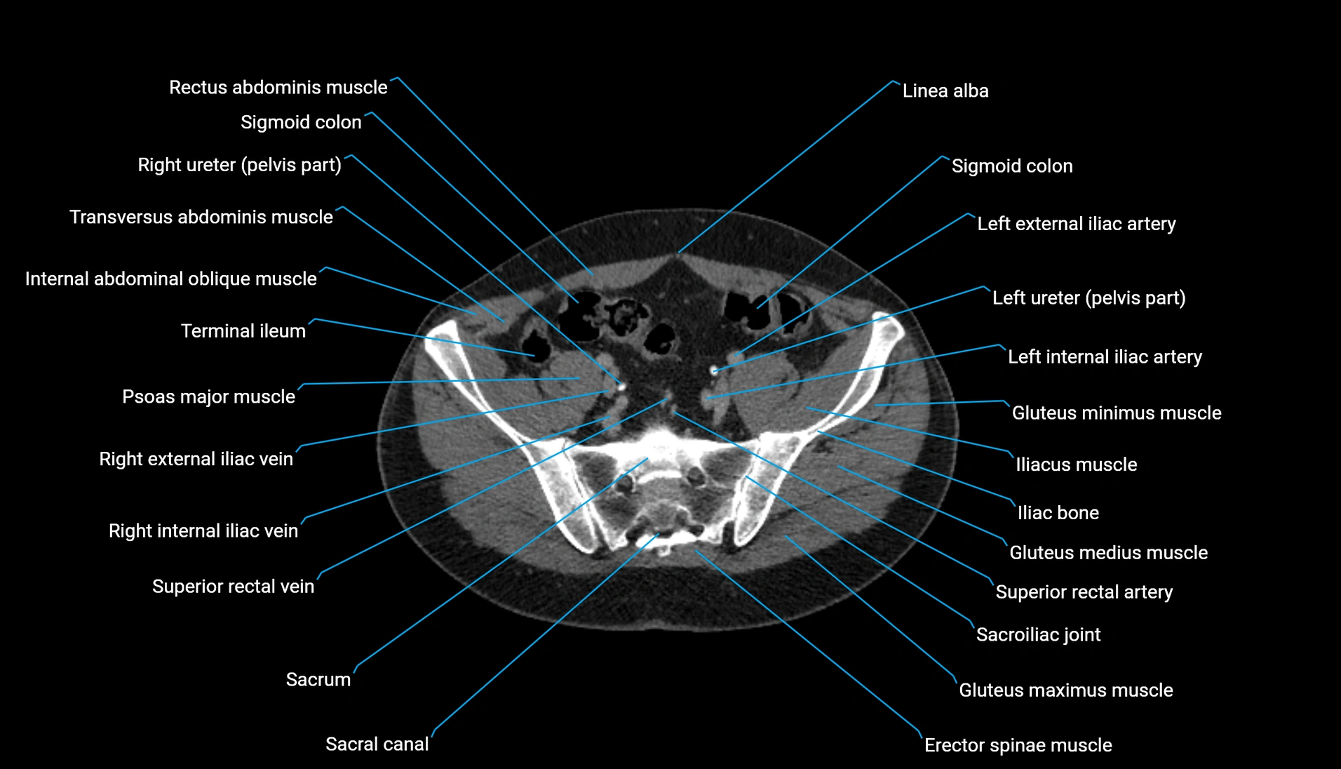 CT urogram axial cross sectional anatomy  labelled radiology image-00190.webp